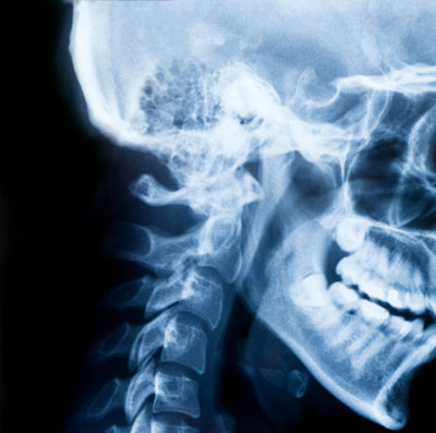 traumatismes craniens